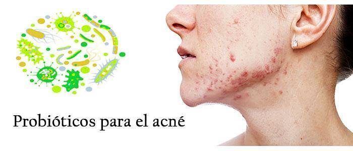 Acne treatment with S. boulardii probiotics